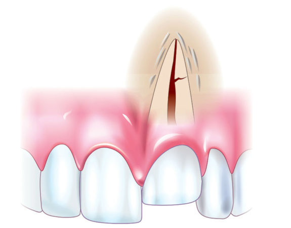 Основная причина зубной боли — стоматологические заболевания