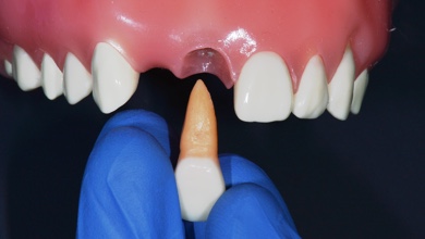 реплантация зуба по шагам