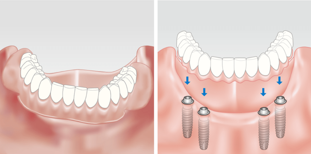 Зубные протезы на имплантах. Съемный протез на 4 имплантах. Несъемные зубные протезы на 4 имплантах.