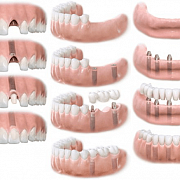 Имплантация – быстрое, надежное и эстетичное восстановление зубов