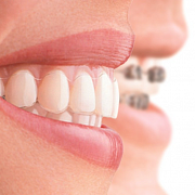 Ровные зубы без брекетов – это возможно?
