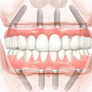 «Всё на 4х» имплантатах – скорая помощь при полном отсутствии зубов
